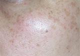 脈衝光雷射, 脈衝光除斑 - 治療前：光老化肌膚