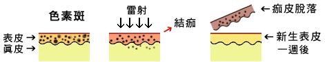 雷射除斑,除斑雷射 - 表淺的色素圖示
