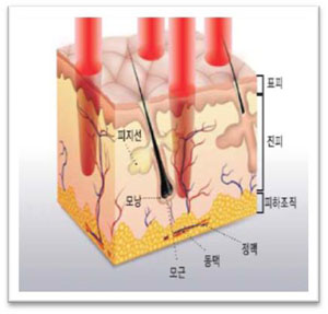 魔顏雷射,雷射除痘疤-毛囊圖例