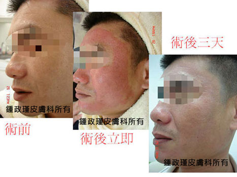 術前術後
